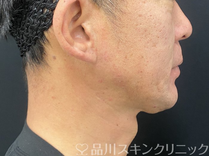 症例NO.73926のAFTER写真