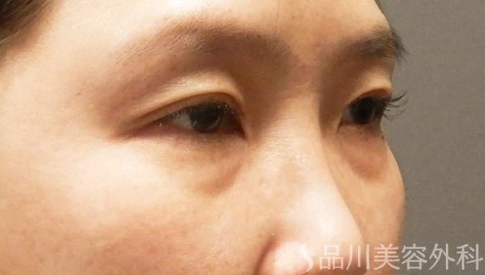 症例NO.65766のBEFORE写真