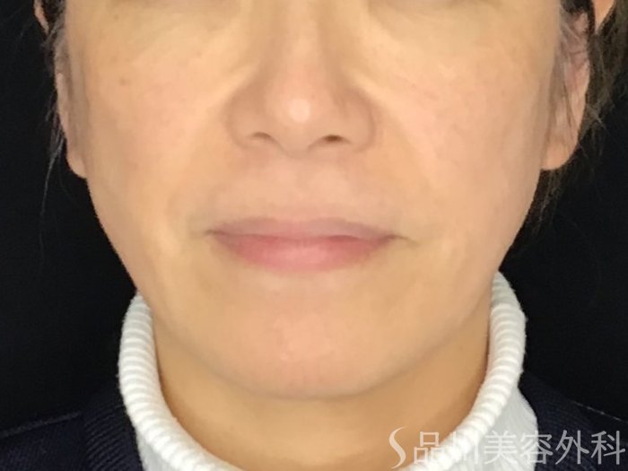 症例NO.67828のBEFORE写真