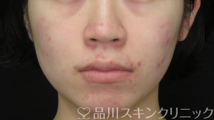 症例NO.71888のAFTER写真