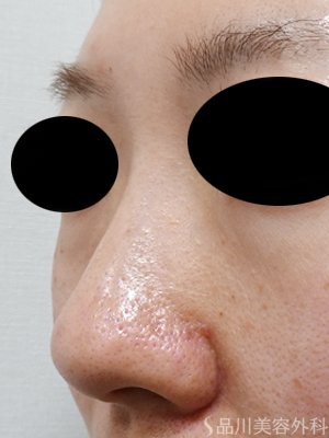 症例NO.75176のBEFORE写真