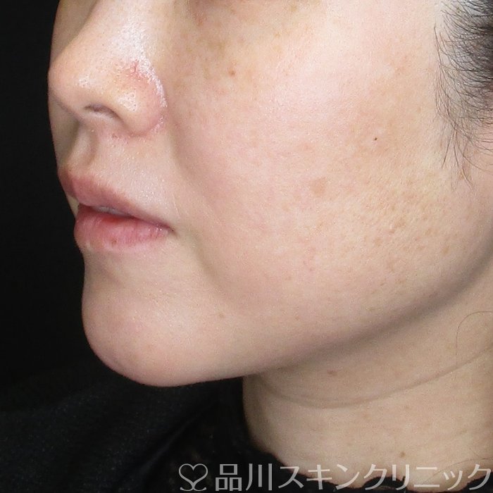 症例NO.73697のBEFORE写真