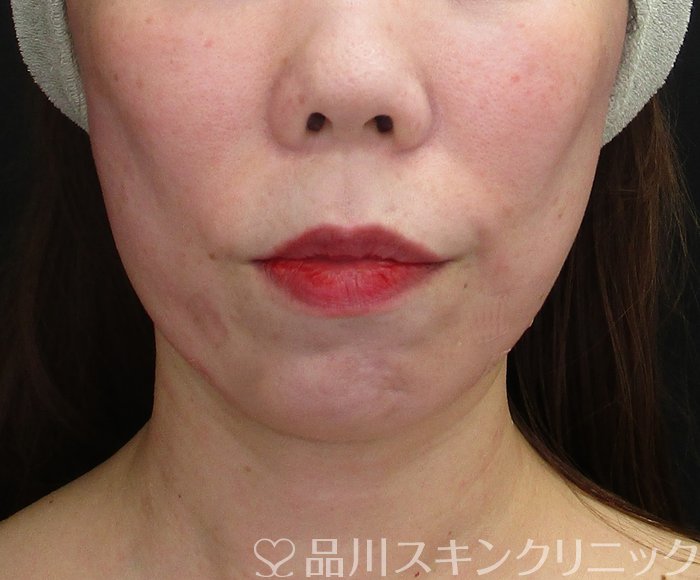 症例NO.73610のAFTER写真