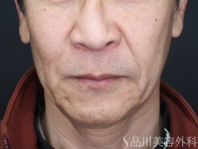 症例NO.73471のBEFORE写真