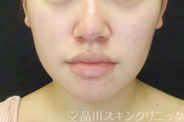 症例NO.65040のAFTER写真