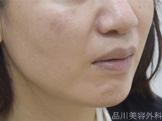 症例NO.51623のAFTER写真