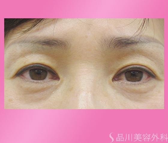 症例NO.505のBEFORE写真