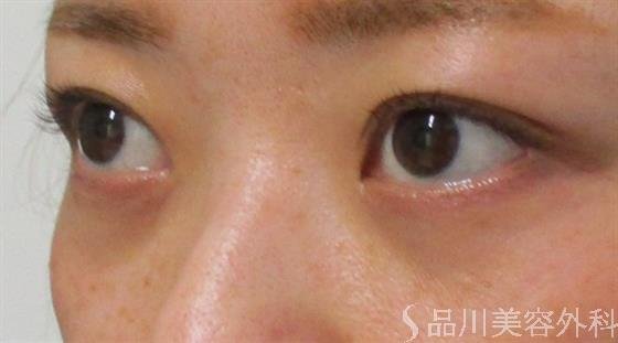 症例NO.53418のAFTER写真