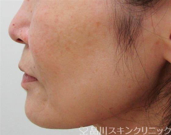 症例NO.30995のAFTER写真