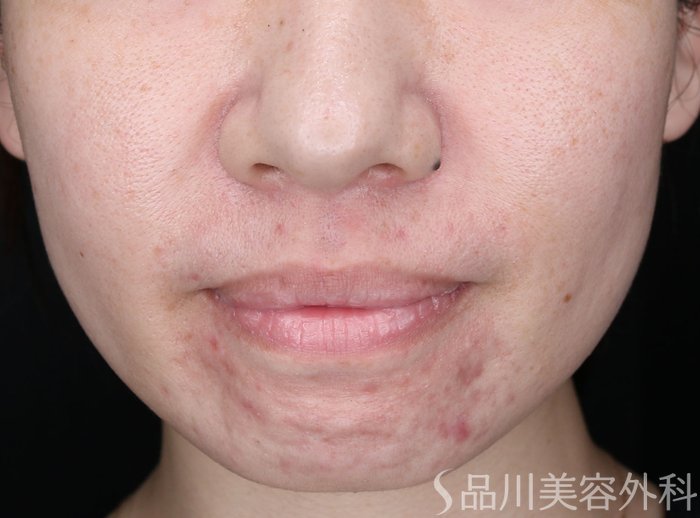 症例NO.74774のBEFORE写真