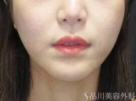 症例NO.71864のAFTER写真