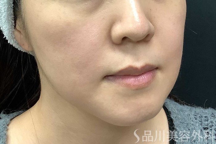 症例NO.63013のBEFORE写真