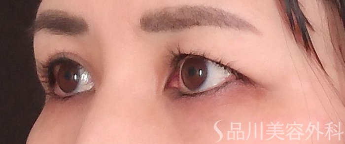 症例NO.70342のBEFORE写真