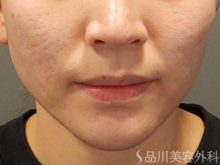 症例NO.69208のBEFORE写真
