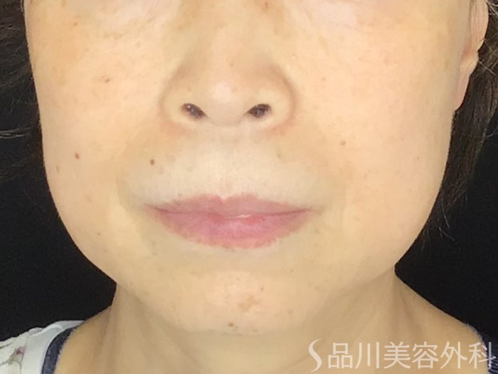 症例NO.67606のBEFORE写真
