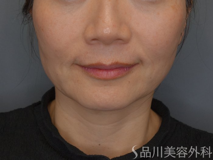 症例NO.74803のBEFORE写真