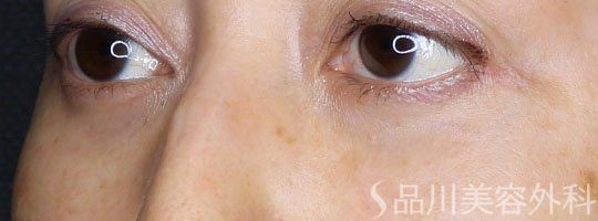 症例NO.72730のAFTER写真