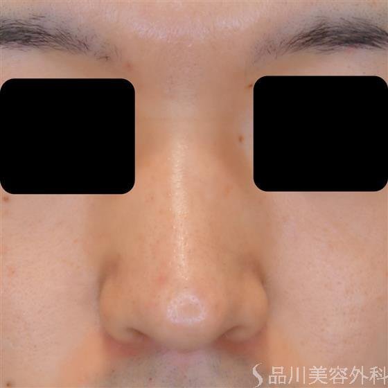 症例NO.53702のBEFORE写真