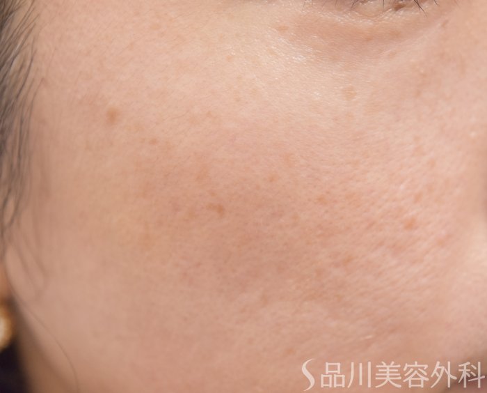 症例NO.66262のAFTER写真