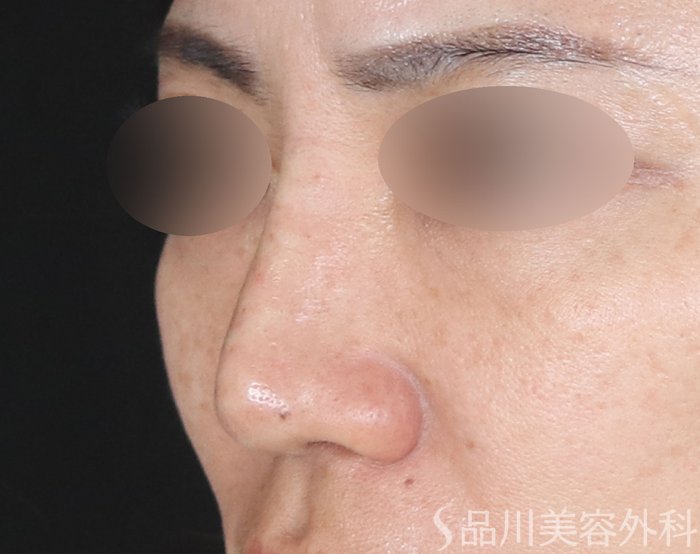 症例NO.72216のAFTER写真