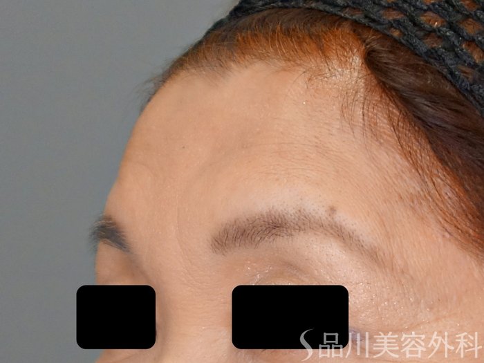 症例NO.70146のBEFORE写真