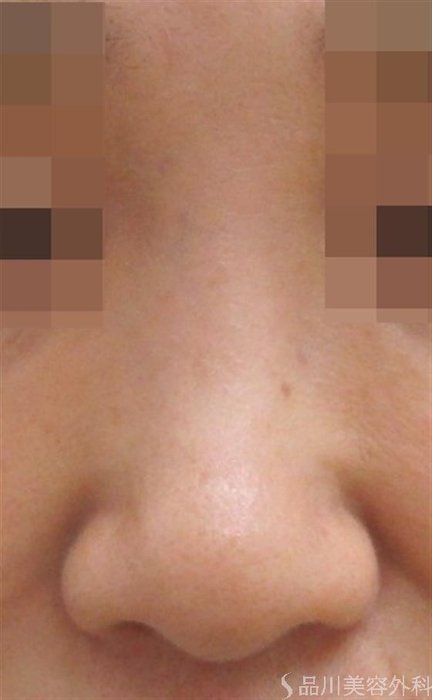 症例NO.44025のBEFORE写真