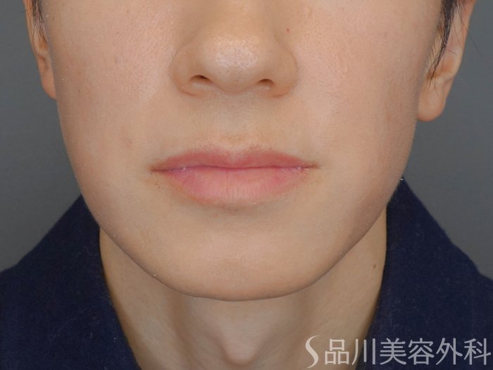 症例NO.73081のBEFORE写真