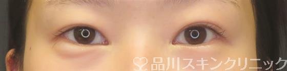 症例NO.59158のBEFORE写真