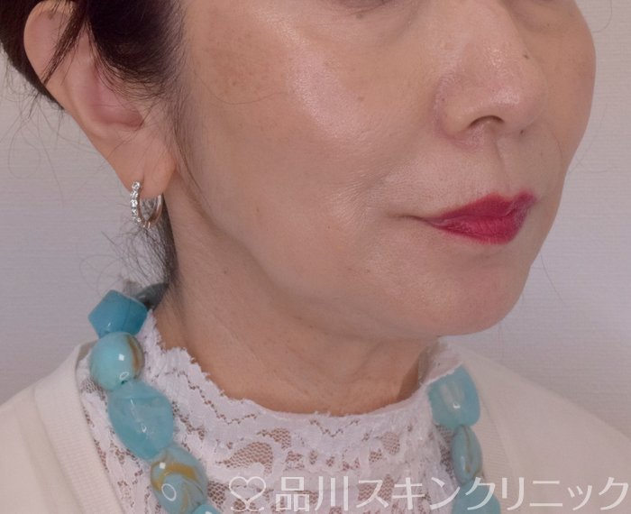 症例NO.70197のAFTER写真