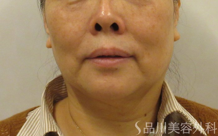 症例NO.73082のBEFORE写真