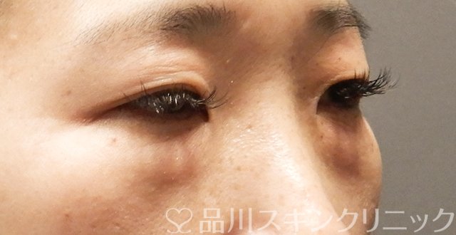 症例NO.64057のBEFORE写真