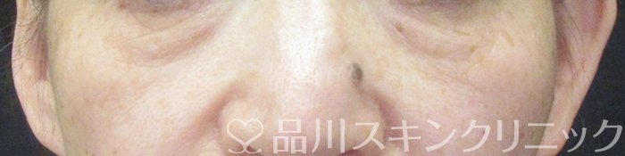症例NO.65304のBEFORE写真