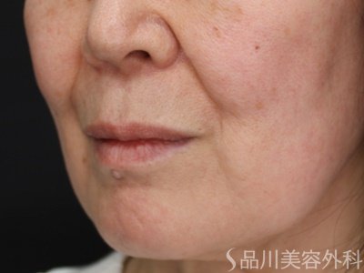症例NO.69788のBEFORE写真