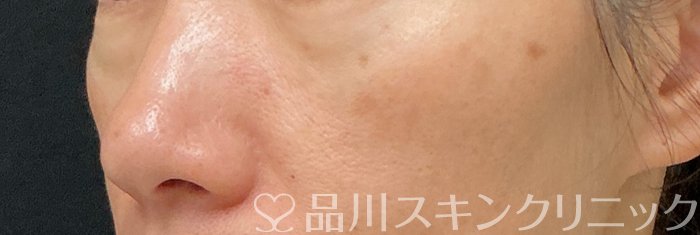 症例NO.74146のBEFORE写真