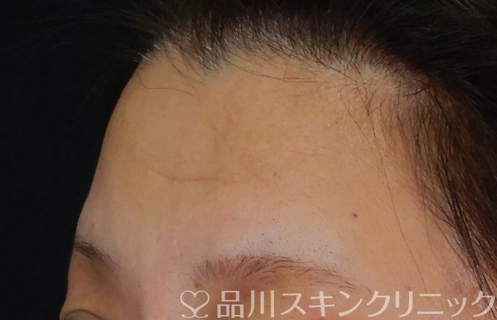 症例NO.66590のBEFORE写真