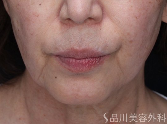 症例NO.71053のBEFORE写真