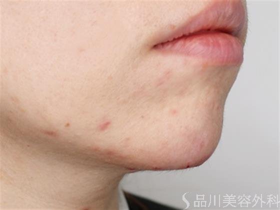 症例NO.51010のAFTER写真