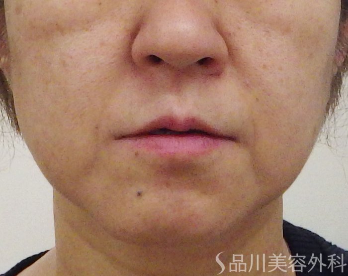 症例NO.69386のBEFORE写真