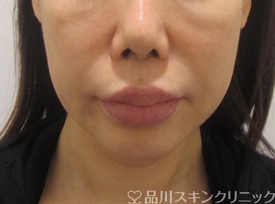 症例NO.33457のBEFORE写真