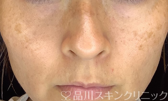 症例NO.69498のBEFORE写真