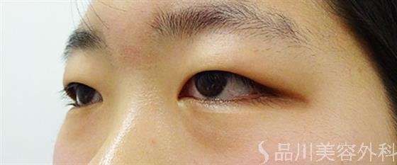 症例NO.34412のBEFORE写真