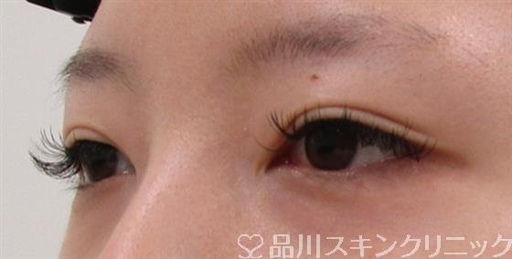 症例NO.42069のBEFORE写真