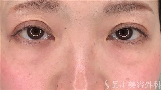 症例NO.60315のBEFORE写真