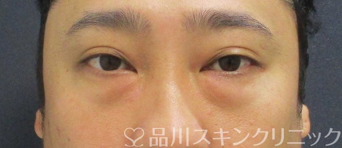 症例NO.62040のBEFORE写真