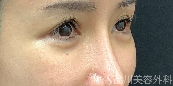 症例NO.67804のBEFORE写真