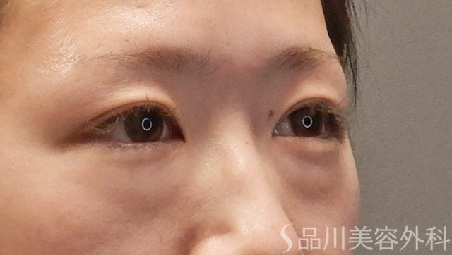 症例NO.73677のBEFORE写真