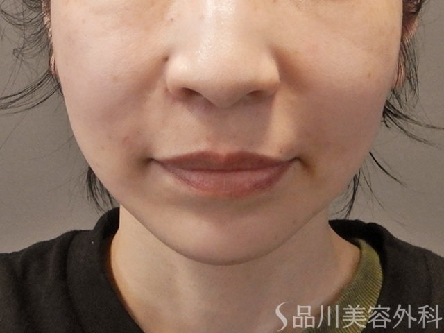 症例NO.74340のAFTER写真