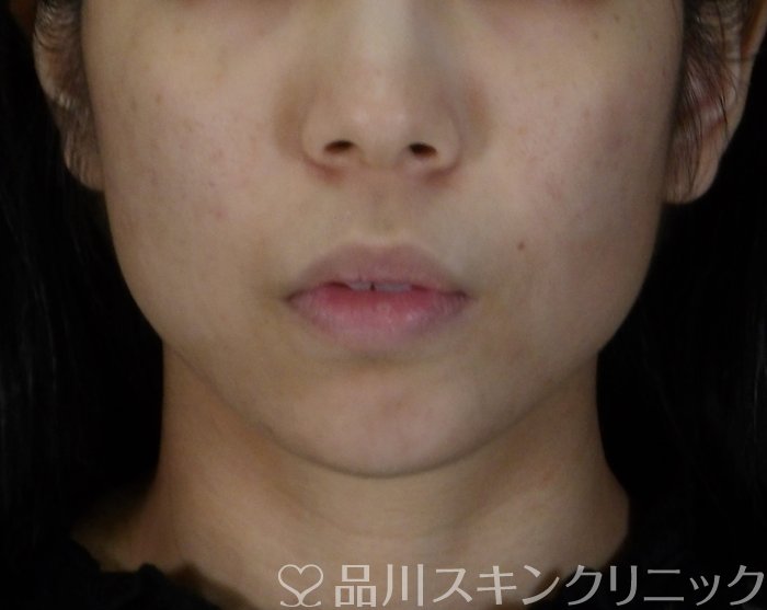 症例NO.67482のAFTER写真