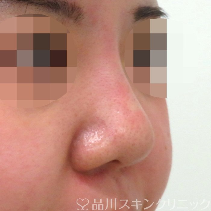 症例NO.70202のAFTER写真