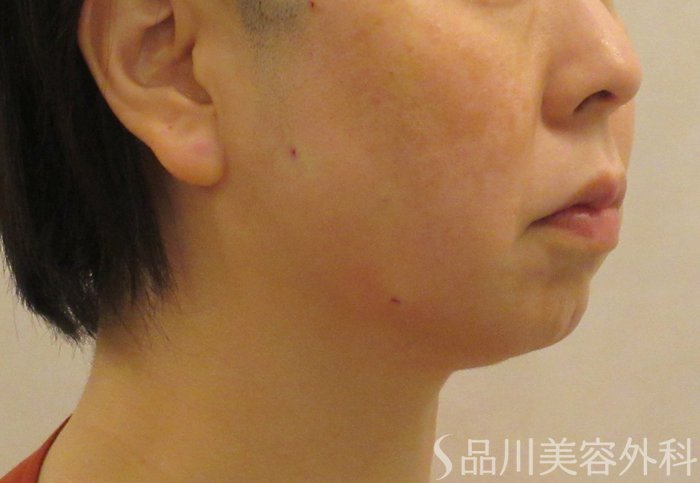 症例NO.71377のAFTER写真